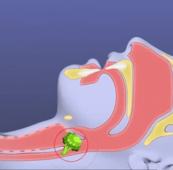 AirwayClear Anti-Choking Device